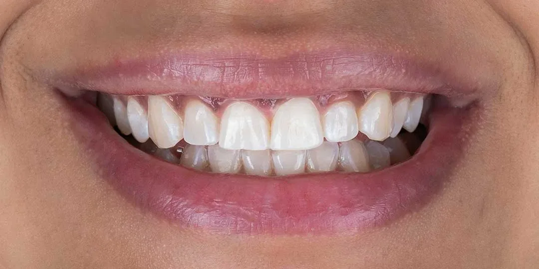 After Guided Biofilm Therapy & Whitening Treatment